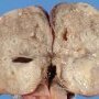Extralobar pulmonary sequestration
