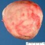 Necrobiotic subserosal uterine leiomyoma