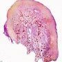 Toe osteoma