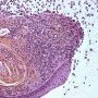 Salivary mucocele