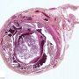 Ectopic tubal pregnancy