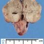 Extralobar pulmonary sequestration