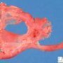 Bilateral diaphragmatic hernia in malformative syndrome