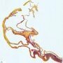 Splenic multilocular mesothelial cysts