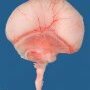 Alobar holoprosencephaly