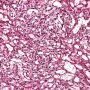 Yolk sac tumor