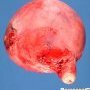 Parietal uterine leiomyoma