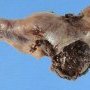 Ectopic tubal pregnancy