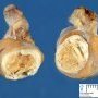 Testicular dermoid cyst