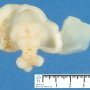 Alobar holoprosencephaly