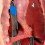 Bilateral diaphragmatic hernia in malformative syndrome