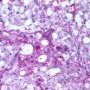 Yolk sac tumor
