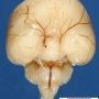 Alobar holoprosencephaly