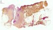Cutaneous fistula complicating a chronic osteomyelitis