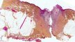 Cutaneous fistula complicating a chronic osteomyelitis