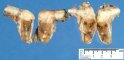 Multiple testicular adenomas in androgen insentivity syndrome