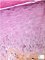 Cutaneous GVH