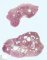 Colonic juvenile polyp