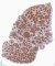 CD20+ nodules in nodular lymphocyte-predominant Hodgkin lymphoma
