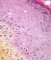 Cutaneous GVH