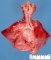 Meconial aspiration in a neonate