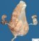 Prune belly sequence by urethral obstruction sequence with megacystis (Case (...)