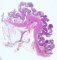 Lymphoid polyposis (multiple lymphoid polyps)