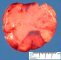 Mesenteric lipoma
