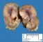 Colonic Peutz-Jeghers polyp