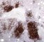 Pulmonary nodular lymphoid hyperplasia