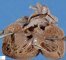Ventricular septal defect