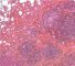 Pulmonary nodular lymphoid hyperplasia
