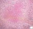 Pulmonary necrotizing granulomatosis and granulomatous vasculitis (etiology (...)