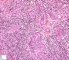 Atypical salivary lymphoid hyperplasia
