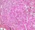 Massive hepatic necrosis in fulminant auto-immune hepatitis