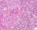 Atypical salivary lymphoid hyperplasia