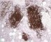Pulmonary nodular lymphoid hyperplasia