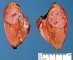 Small hepatoblastoma