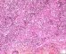 Atypical salivary lymphoid hyperplasia