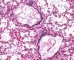 Meconial and amniotic aspiration in a newborn