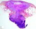 Infectious fistula from lymph node to the skin after a mycobacterial (...)