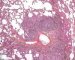 Pulmonary nodular lymphoid hyperplasia