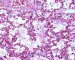 Meconial and amniotic aspiration in a newborn