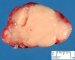 Nodular lymphocyte-predominant Hodgkin lymphoma