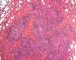 Pulmonary nodular lymphoid hyperplasia