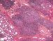 Pulmonary nodular lymphoid hyperplasia