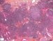 Pulmonary nodular lymphoid hyperplasia