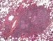Pulmonary nodular lymphoid hyperplasia
