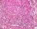 Massive hepatic necrosis in fulminant auto-immune hepatitis