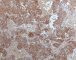 Synaptophysin staining in immature paraganglioma of the vesical (...)
